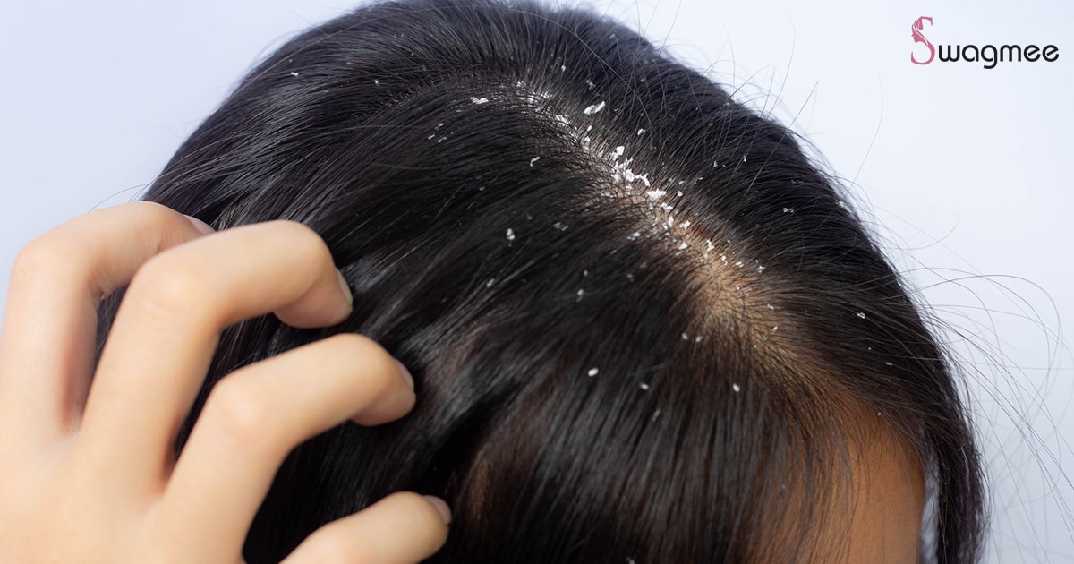 10 Common Dandruff Myths - Busted!