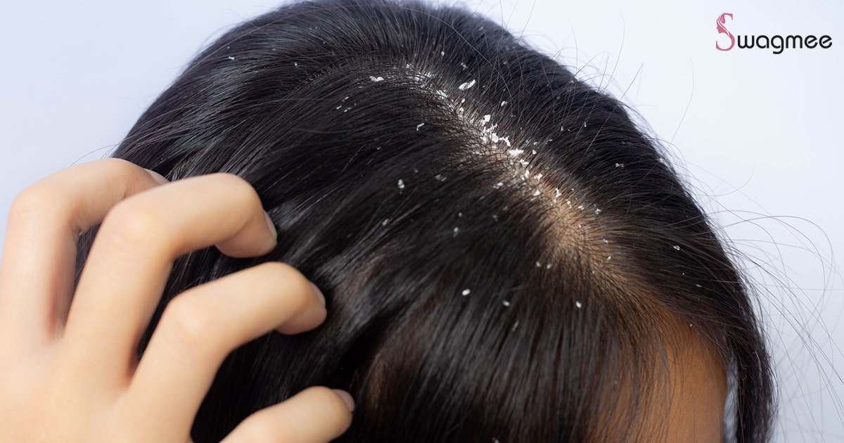 Dandruff Problem